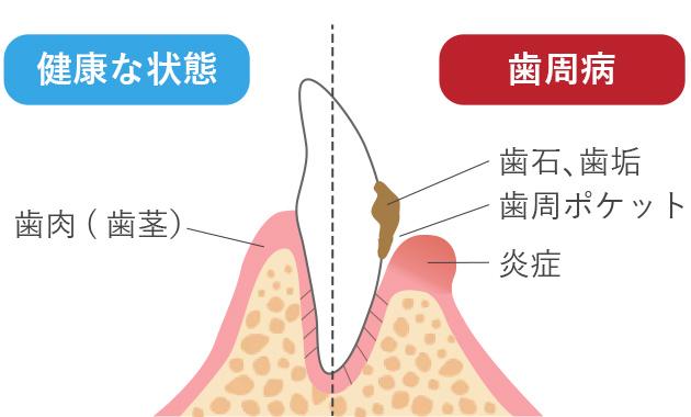 犬の歯 健康な状態と歯周病の状態の比較